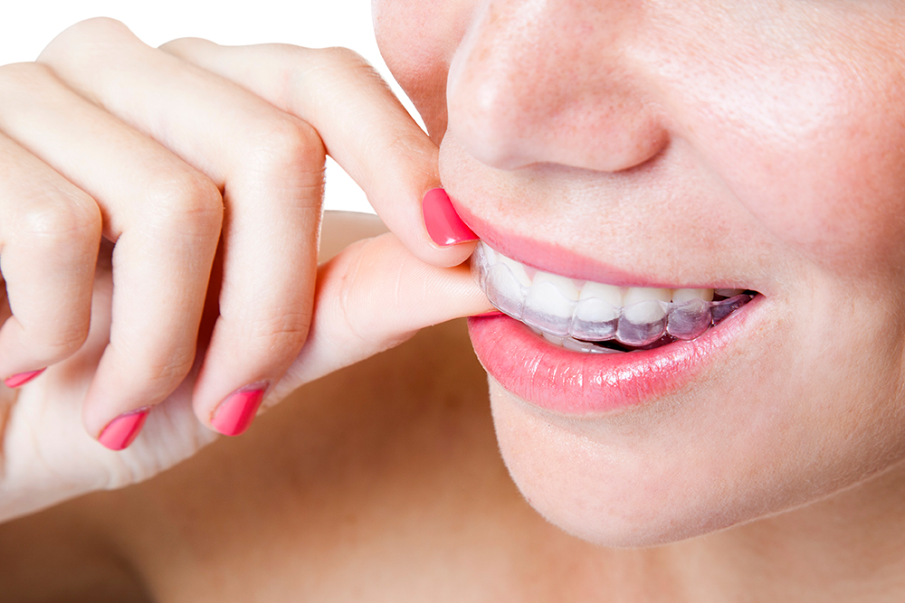 How Long Does Invisalign Take? What Erin Patients Should Know